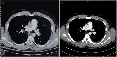 Missense mutation of SERPINC1 (p.Ser426Leu) in a young patient presenting as refractory and recurrent venous thromboembolism: A case report